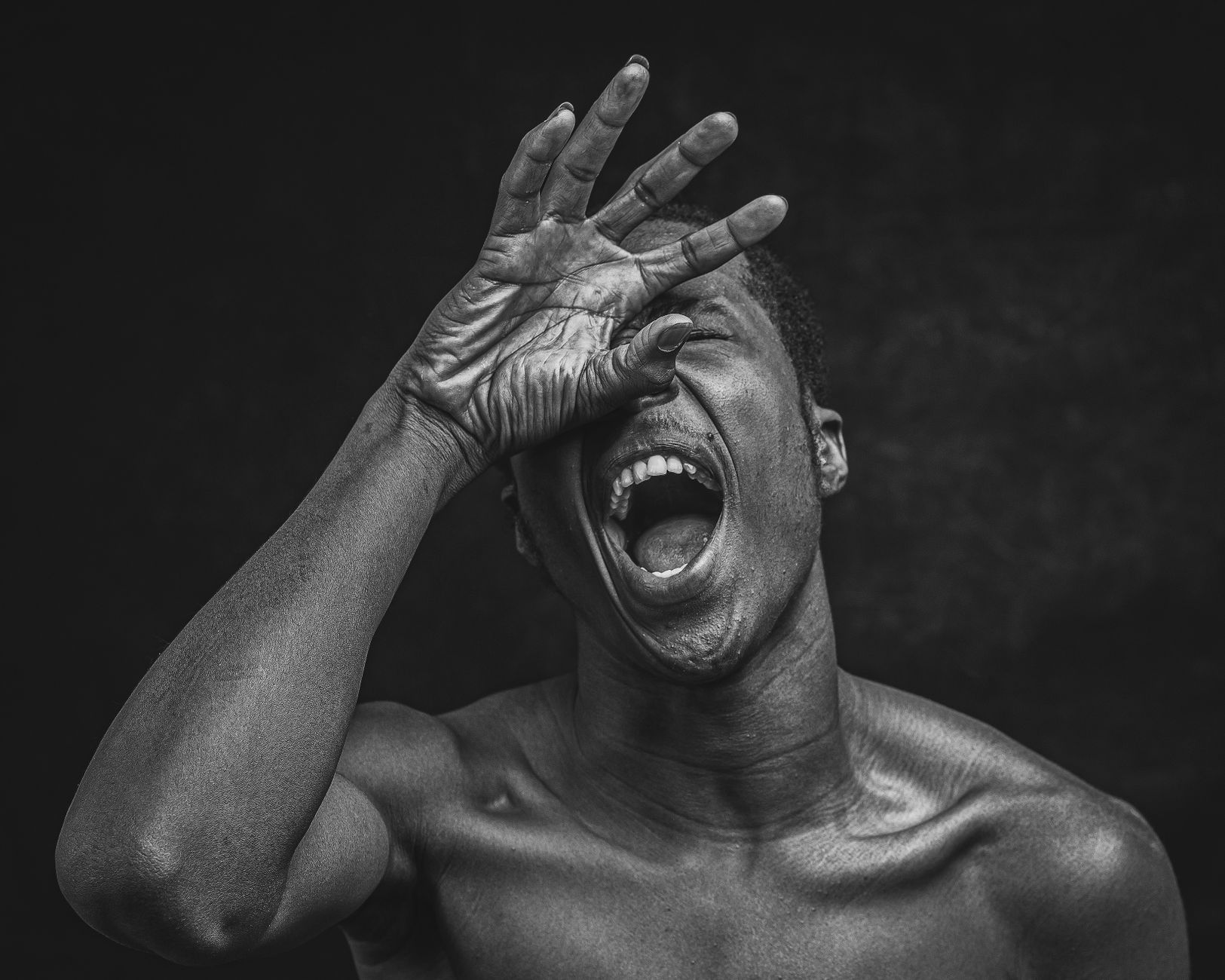 emotional impact of gynecomastia